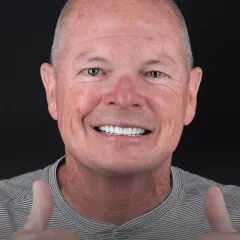 Dental Implants Icon: Icon representing dental implants